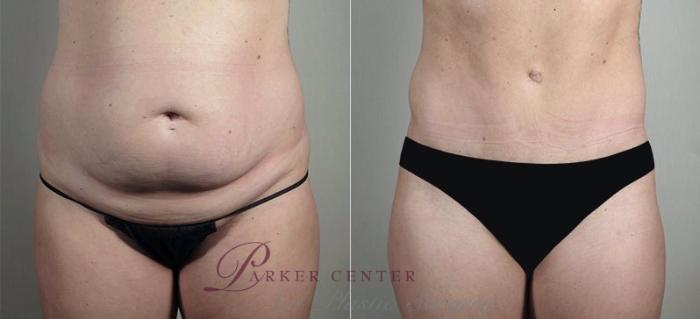 Breast Implant Revision Case 606 Before & After View #3 | Paramus, NJ | Parker Center for Plastic Surgery