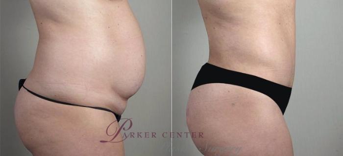 Breast Implant Revision Case 606 Before & After View #4 | Paramus, NJ | Parker Center for Plastic Surgery