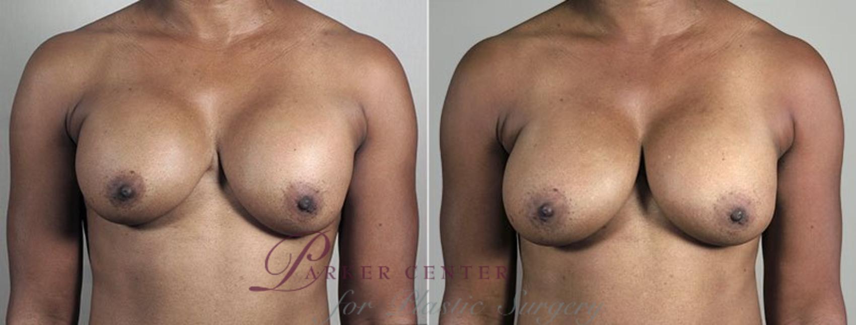 Breast Implant Revision Case 607 Before & After View #1 | Paramus, NJ | Parker Center for Plastic Surgery