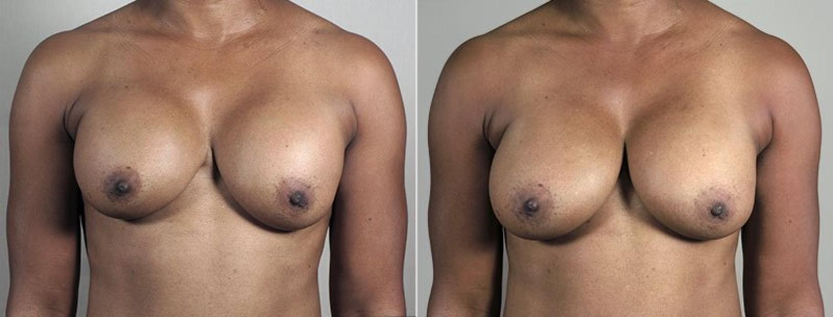 Breast Implant Revision Case 607 Before & After View #1 | Paramus, New Jersey | Parker Center for Plastic Surgery