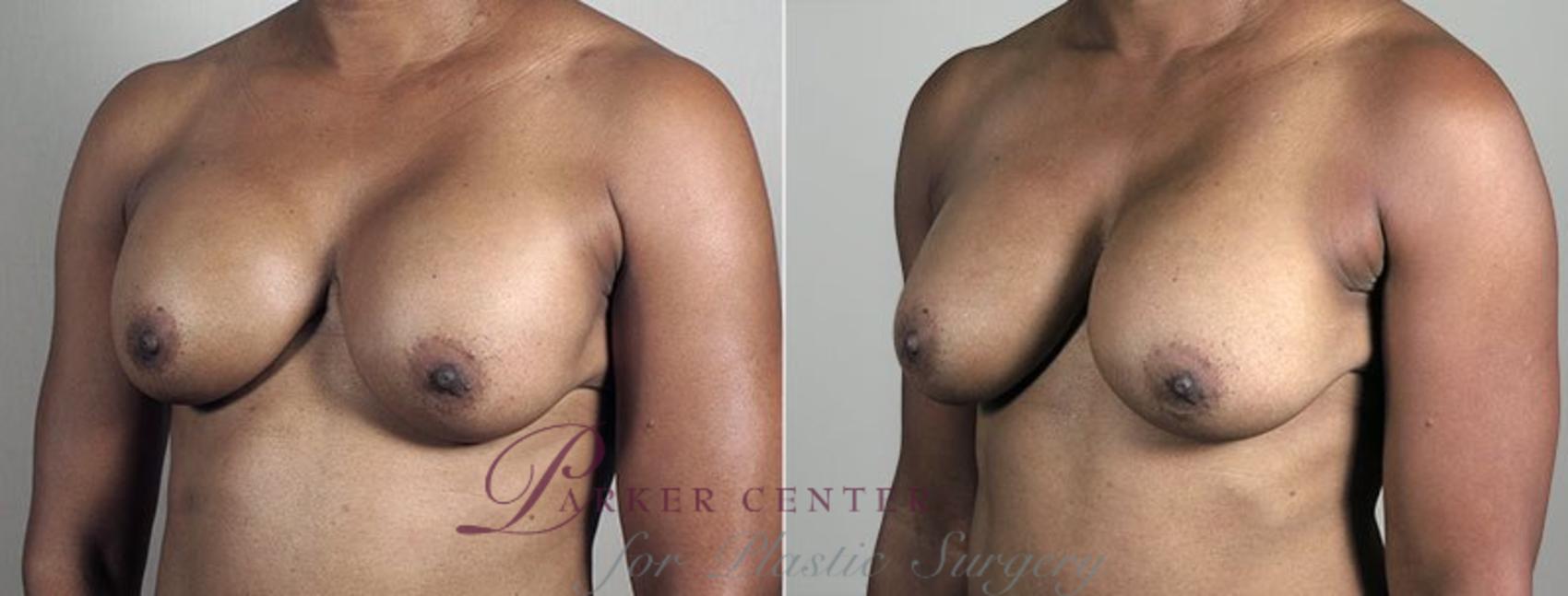 Breast Implant Revision Case 607 Before & After View #2 | Paramus, NJ | Parker Center for Plastic Surgery