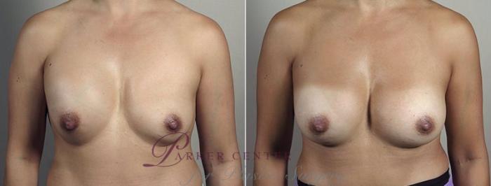 Breast Implant Revision Case 608 Before & After View #1 | Paramus, NJ | Parker Center for Plastic Surgery
