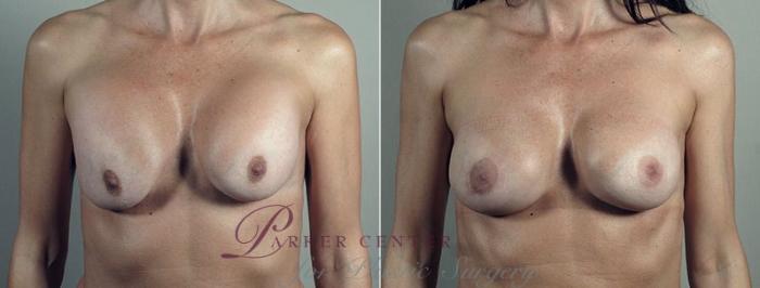Breast Implant Revision Case 609 Before & After View #1 | Paramus, NJ | Parker Center for Plastic Surgery