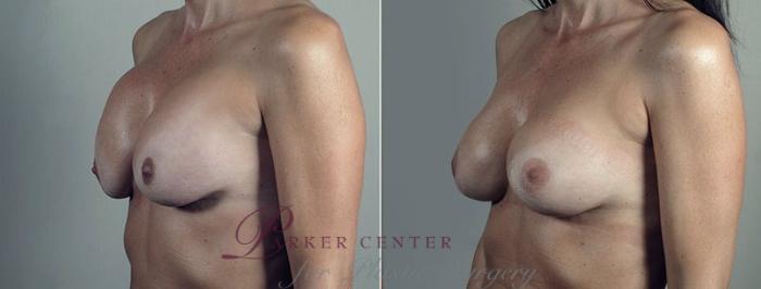Breast Implant Revision Case 609 Before & After View #2 | Paramus, NJ | Parker Center for Plastic Surgery