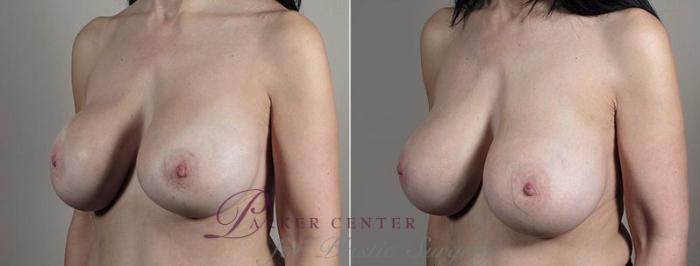 Breast Implant Revision Case 610 Before & After View #2 | Paramus, NJ | Parker Center for Plastic Surgery