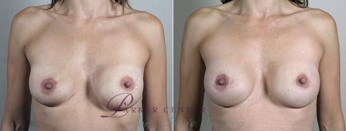 Breast Implant Revision Case 611 Before & After View #1 | Paramus, NJ | Parker Center for Plastic Surgery