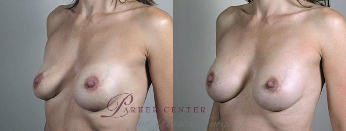 Breast Implant Revision Case 611 Before & After View #2 | Paramus, NJ | Parker Center for Plastic Surgery