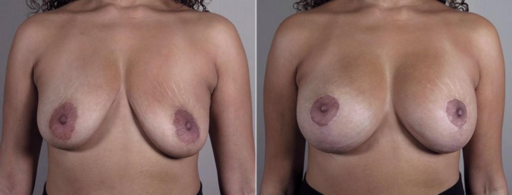 Breast Implant Revision Case 612 Before & After View #1 | Paramus, NJ | Parker Center for Plastic Surgery