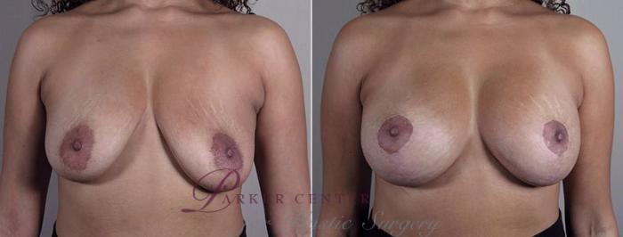 Breast Implant Revision Case 612 Before & After View #1 | Paramus, NJ | Parker Center for Plastic Surgery