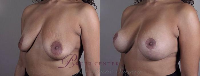 Breast Implant Revision Case 612 Before & After View #2 | Paramus, NJ | Parker Center for Plastic Surgery