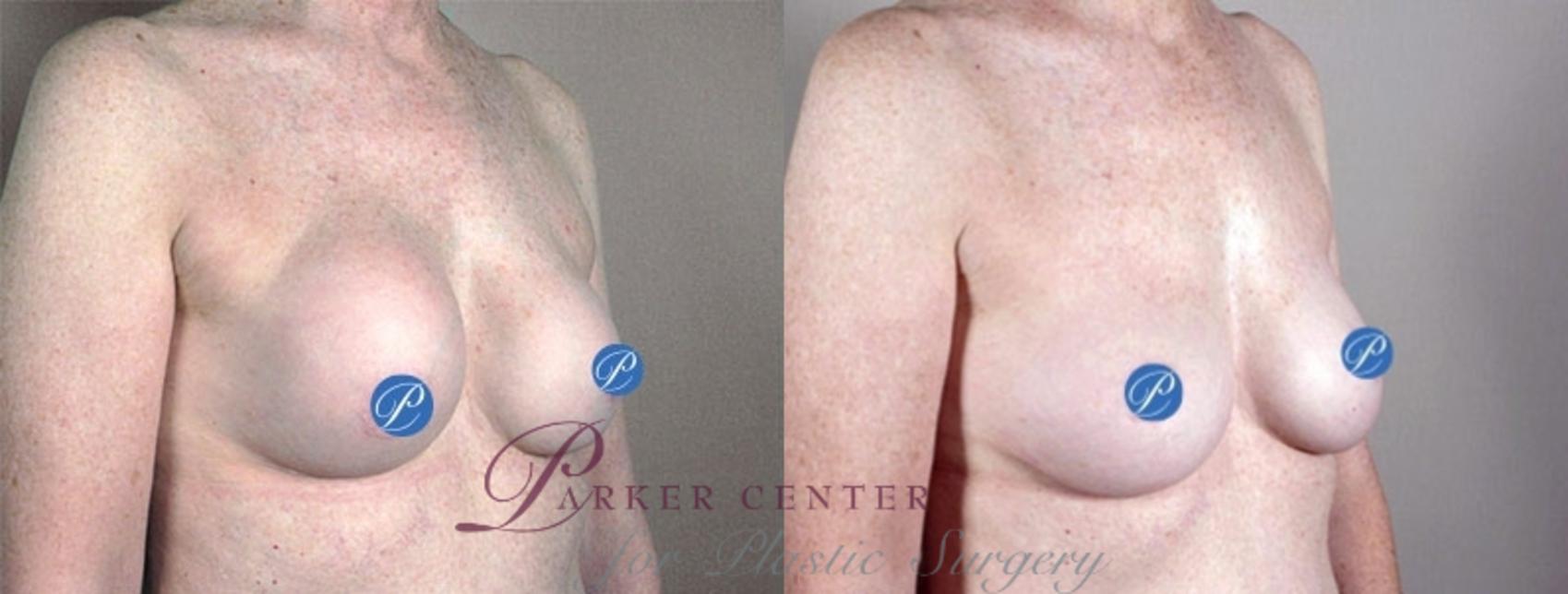 Breast Implant Revision Case 905 Before & After View #5 | Paramus, NJ | Parker Center for Plastic Surgery