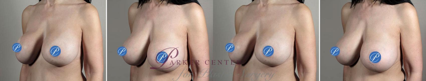 Breast Implant Revision Case 906 Before & After View #5 | Paramus, NJ | Parker Center for Plastic Surgery