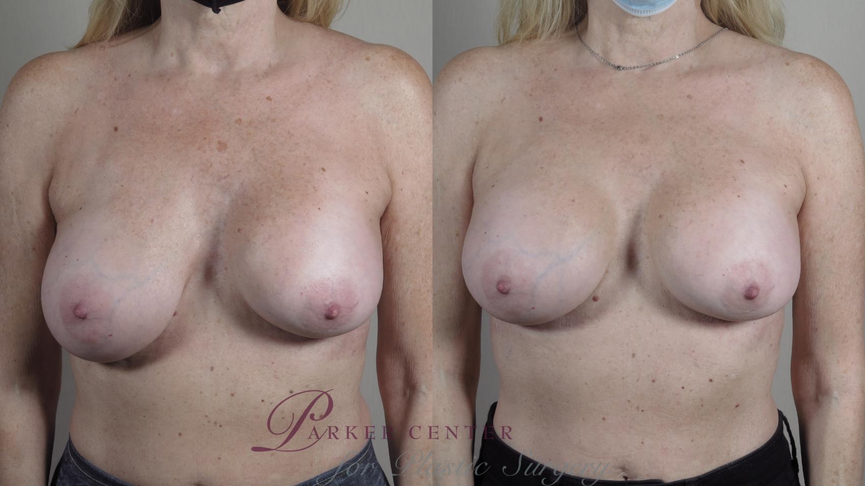 Breast Implant Revision Case 966 Before & After Front | Paramus, New Jersey | Parker Center for Plastic Surgery