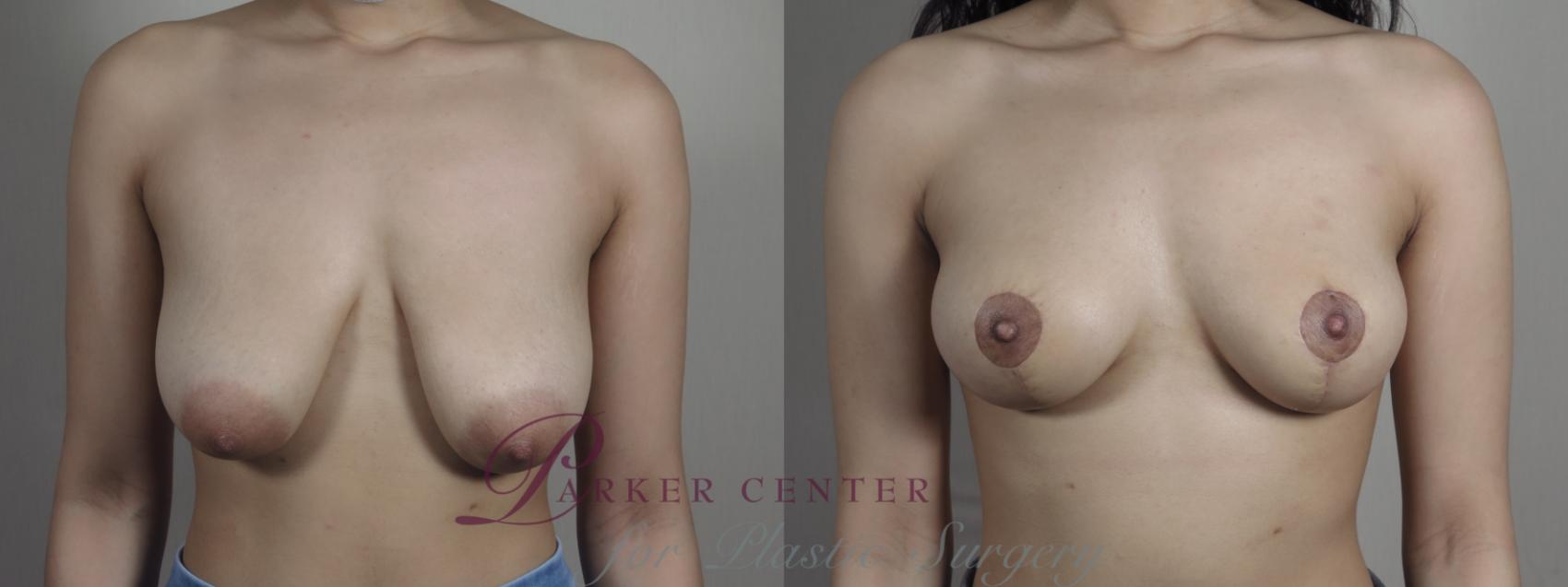 Breast Lift Case 1028 Before & After Front | Paramus, NJ | Parker Center for Plastic Surgery