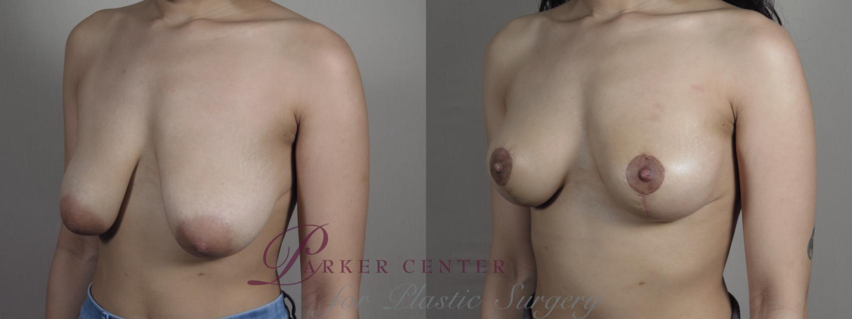 Breast Lift Case 1028 Before & After Right Oblique | Paramus, New Jersey | Parker Center for Plastic Surgery