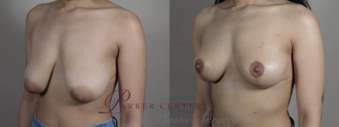 Breast Lift Case 1028 Before & After Right Oblique | Paramus, NJ | Parker Center for Plastic Surgery