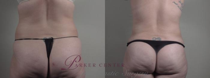 Breast Lift Case 1298 Before & After Back | Paramus, NJ | Parker Center for Plastic Surgery