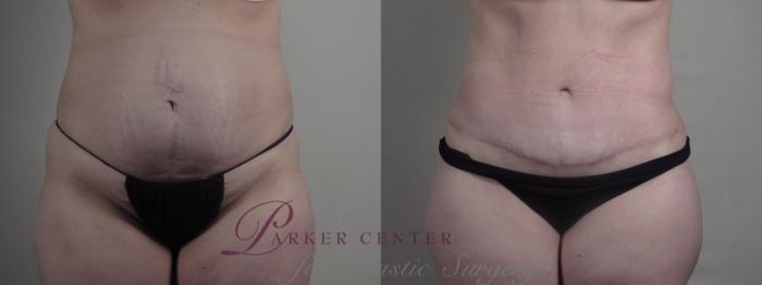 Breast Lift Case 1298 Before & After front  | Paramus, NJ | Parker Center for Plastic Surgery