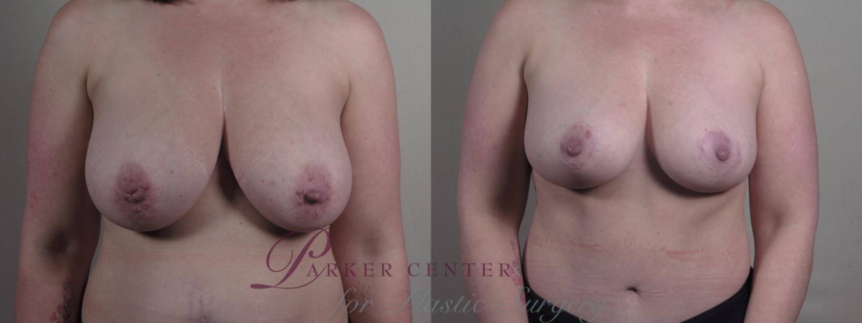 Breast Lift Case 1298 Before & After Front | Paramus, NJ | Parker Center for Plastic Surgery