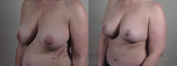 Breast Lift Case 1298 Before & After Left Oblique | Paramus, NJ | Parker Center for Plastic Surgery