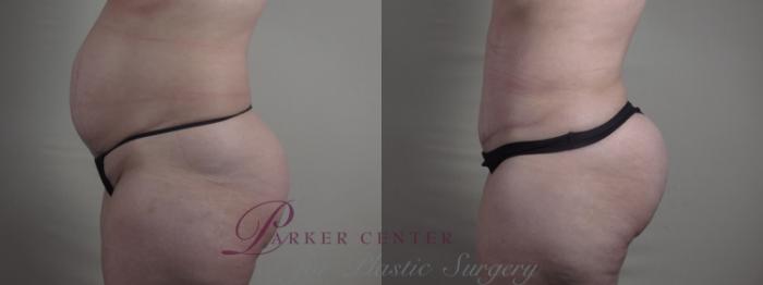 Breast Lift Case 1298 Before & After Left Side | Paramus, NJ | Parker Center for Plastic Surgery