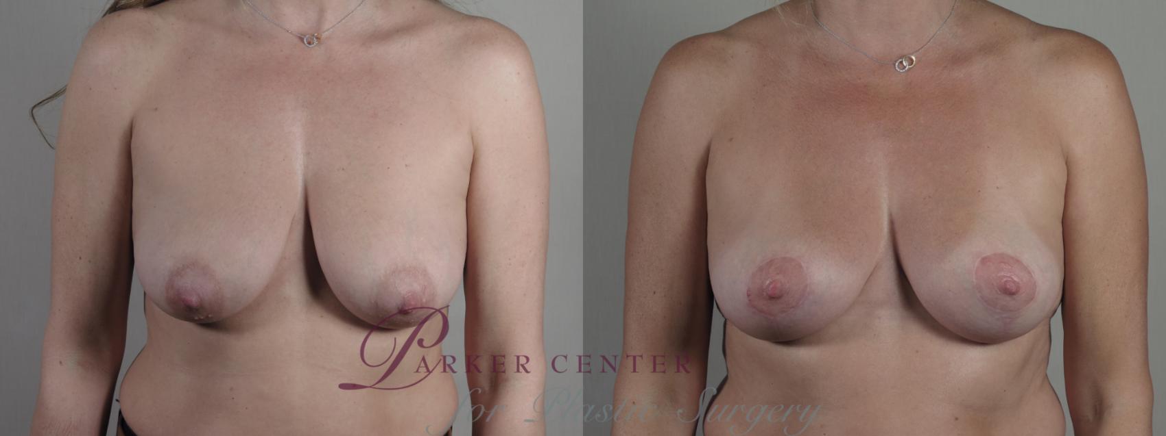 Breast Lift Case 1309 Before & After Front | Paramus, NJ | Parker Center for Plastic Surgery