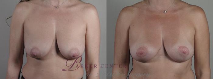 Breast Lift Case 1309 Before & After Front | Paramus, NJ | Parker Center for Plastic Surgery