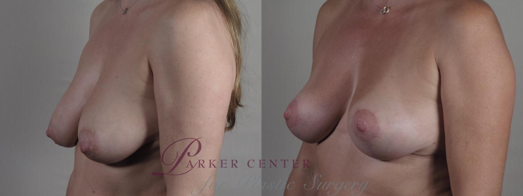 Breast Lift Case 1309 Before & After Left Oblique | Paramus, New Jersey | Parker Center for Plastic Surgery