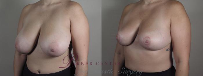 Breast Lift Case 1330 Before & After Left Oblique | Paramus, NJ | Parker Center for Plastic Surgery
