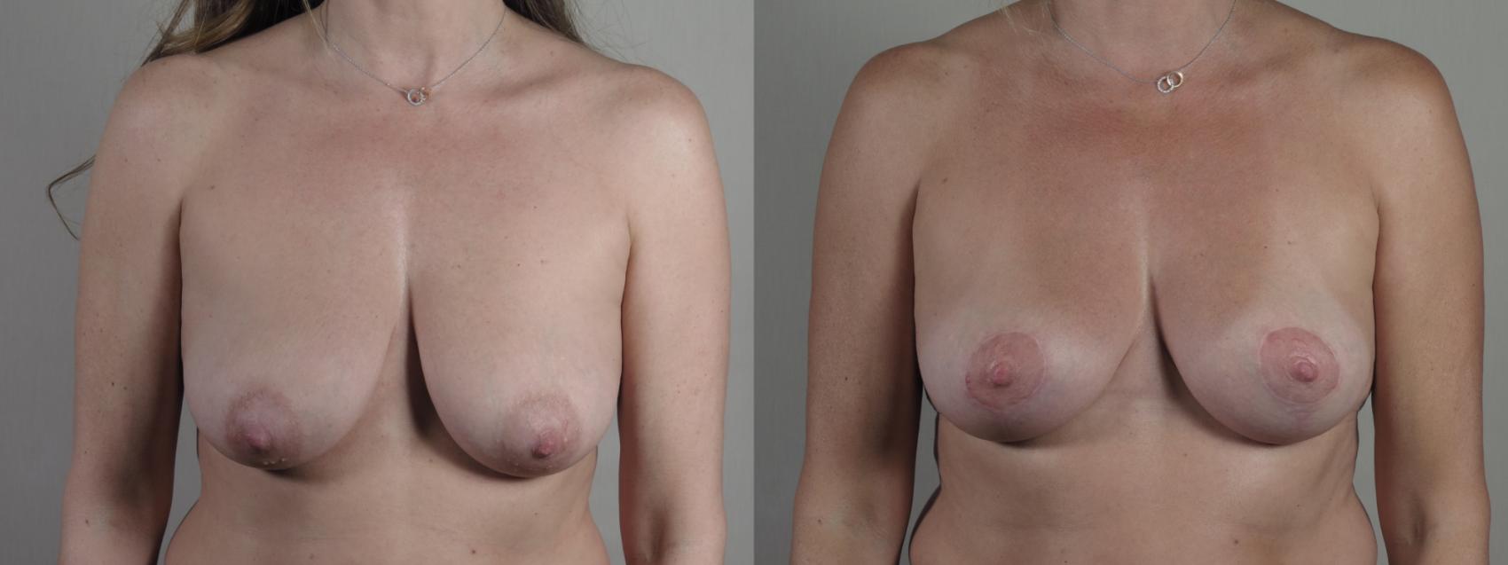 Breast Lift Case 1402 Before & After Front | Paramus, New Jersey | Parker Center for Plastic Surgery