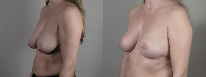 Breast Lift Case 1402 Before & After Side view | Paramus, New Jersey | Parker Center for Plastic Surgery