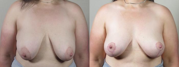 Breast Lift Case 1528 Before & After Front | Paramus, New Jersey | Parker Center for Plastic Surgery