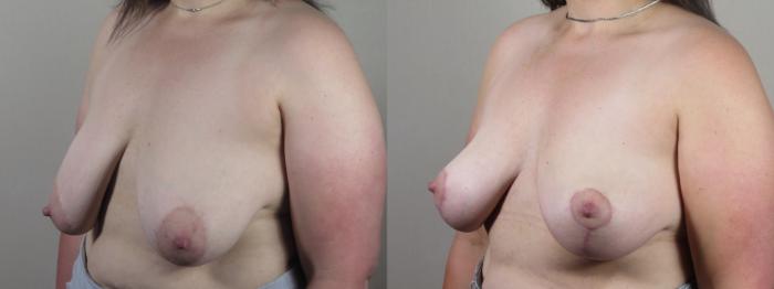 Breast Lift Case 1528 Before & After Left Oblique | Paramus, New Jersey | Parker Center for Plastic Surgery