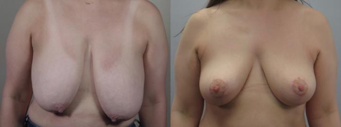 Breast Lift Case 1552 Before & After Front | Paramus, New Jersey | Parker Center for Plastic Surgery