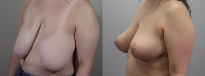 Breast Lift Case 1552 Before & After Left Oblique | Paramus, New Jersey | Parker Center for Plastic Surgery