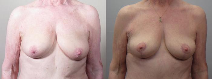 Breast Lift Case 1559 Before & After Front | Paramus, New Jersey | Parker Center for Plastic Surgery