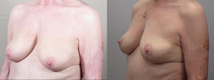 Breast Lift Case 1559 Before & After Left Oblique | Paramus, New Jersey | Parker Center for Plastic Surgery