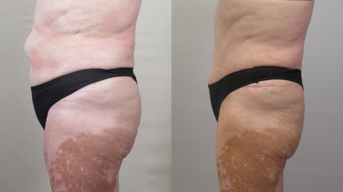 Breast Lift Case 1559 Before & After Left Side | Paramus, New Jersey | Parker Center for Plastic Surgery