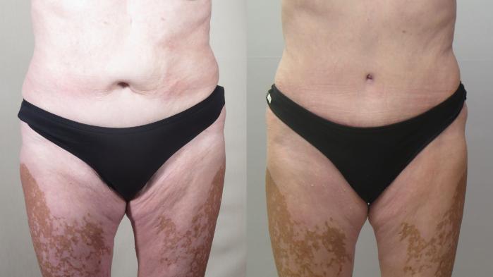 Breast Lift Case 1559 Before & After tt | Paramus, New Jersey | Parker Center for Plastic Surgery
