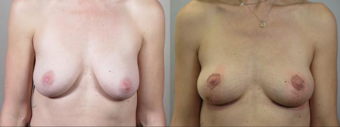 Breast Lift Case 1568 Before & After Front | Paramus, New Jersey | Parker Center for Plastic Surgery
