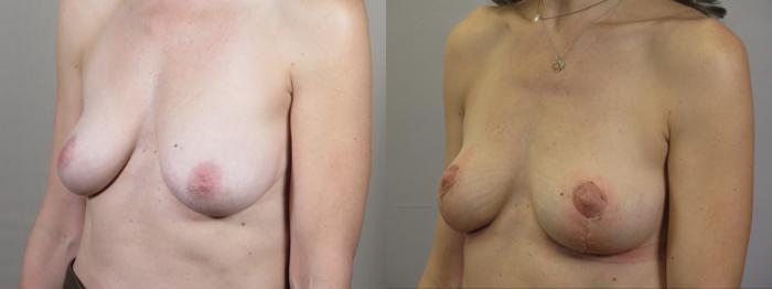 Breast Lift Case 1568 Before & After Left Oblique | Paramus, New Jersey | Parker Center for Plastic Surgery