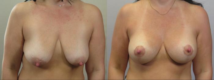 Breast Lift Case 1586 Before & After Front | Paramus, New Jersey | Parker Center for Plastic Surgery