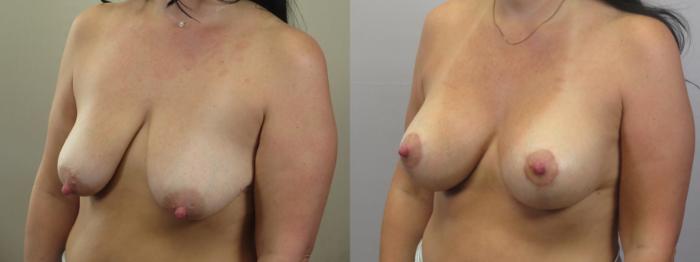 Breast Lift Case 1586 Before & After Left Oblique | Paramus, New Jersey | Parker Center for Plastic Surgery