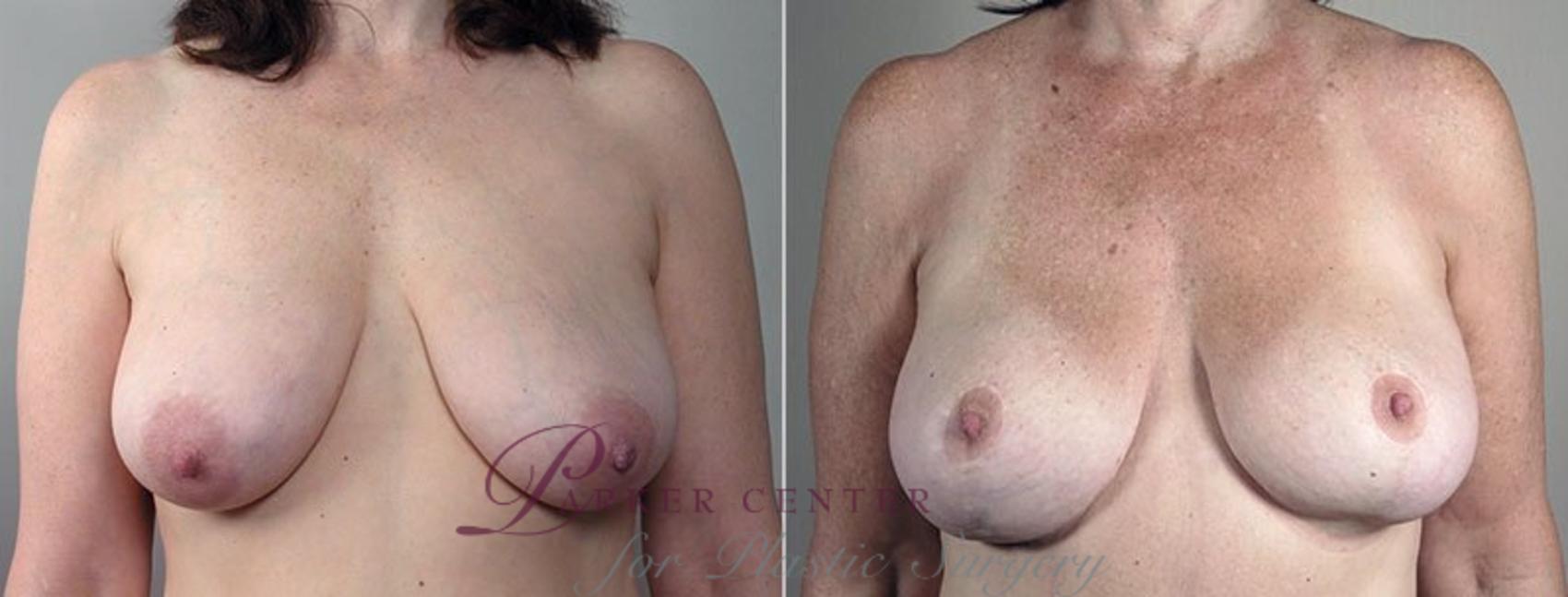 Breast Lift Case 501 Before & After View #1 | Paramus, NJ | Parker Center for Plastic Surgery