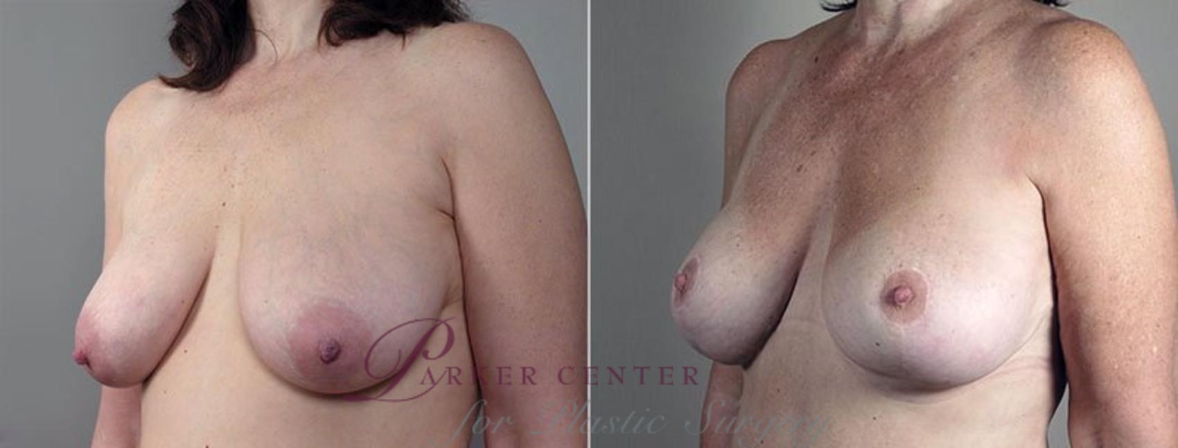 Breast Lift Case 501 Before & After View #2 | Paramus, NJ | Parker Center for Plastic Surgery