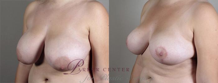 Breast Lift Case 514 Before & After View #2 | Paramus, NJ | Parker Center for Plastic Surgery