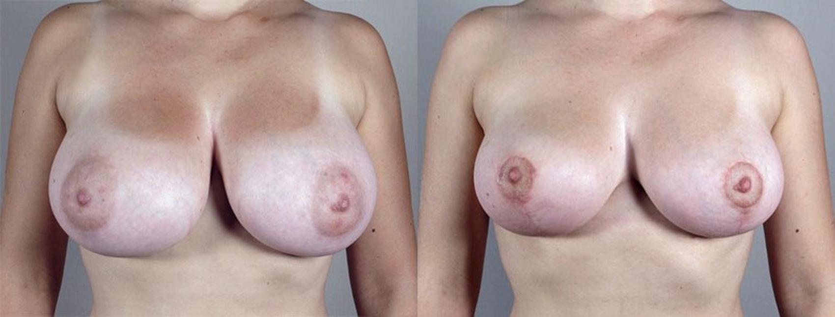 Breast Lift Case 529 Before & After View #1 | Paramus, NJ | Parker Center for Plastic Surgery