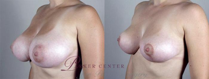 Breast Lift Case 529 Before & After View #2 | Paramus, NJ | Parker Center for Plastic Surgery