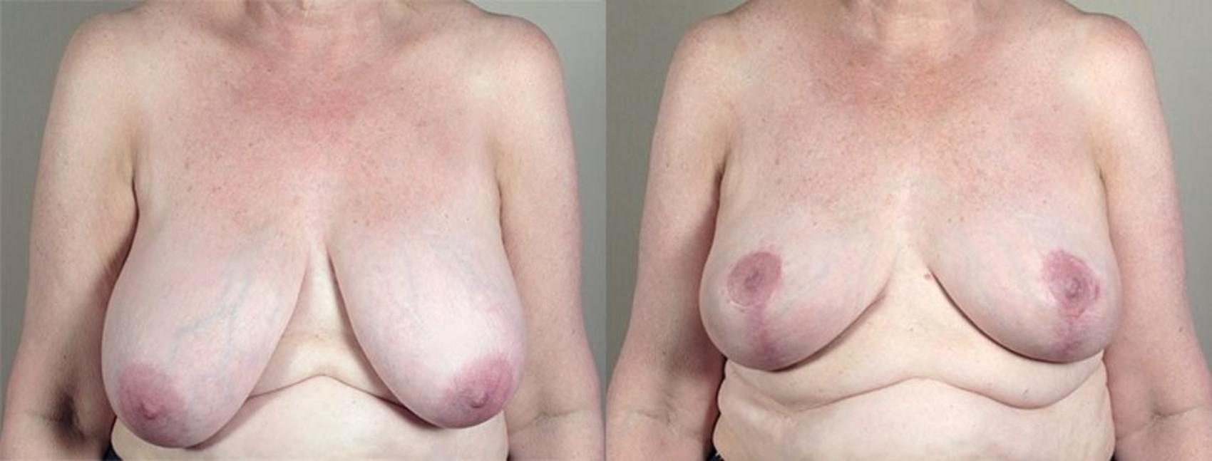 Breast Lift Case 538 Before & After View #1 | Paramus, New Jersey | Parker Center for Plastic Surgery