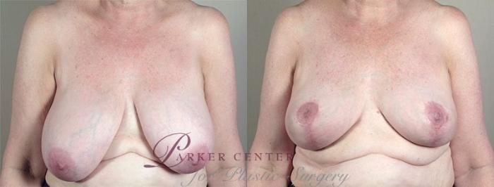 Breast Lift Case 538 Before & After View #1 | Paramus, NJ | Parker Center for Plastic Surgery
